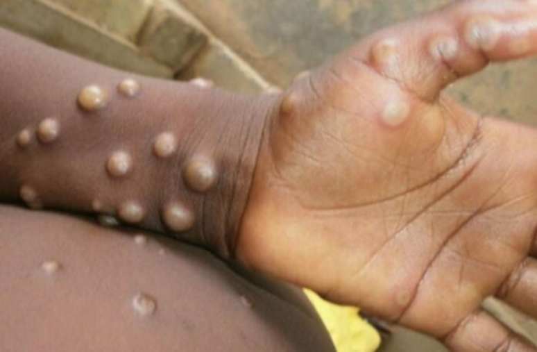 Variole du singe : La Côte d’Ivoire enregistre de nouveaux cas et un décès