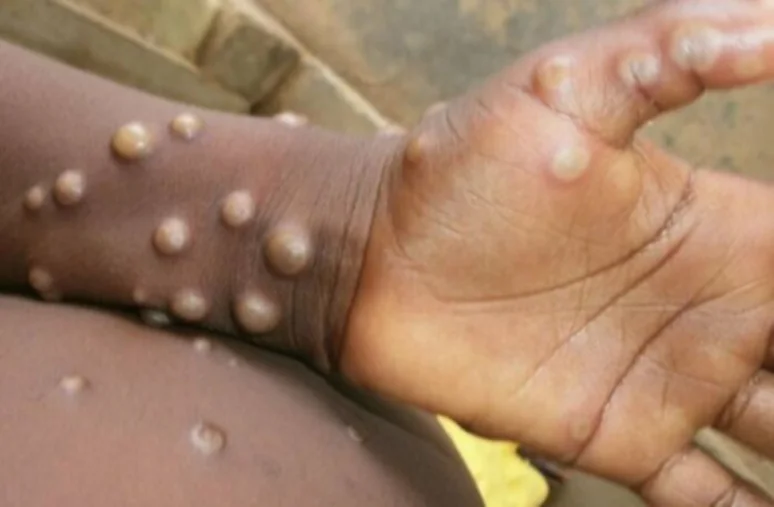 Variole du singe : La Côte d’Ivoire enregistre de nouveaux cas et un décès